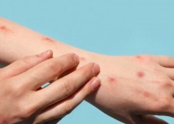 Varíola do Macaco: Maranhão tem caso suspeito