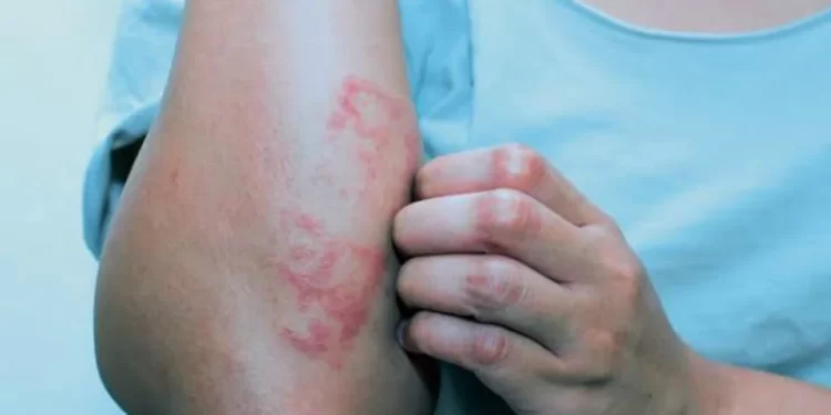 Alerta de diabetes: veja 6 sinais na pele que podem indicar a doença