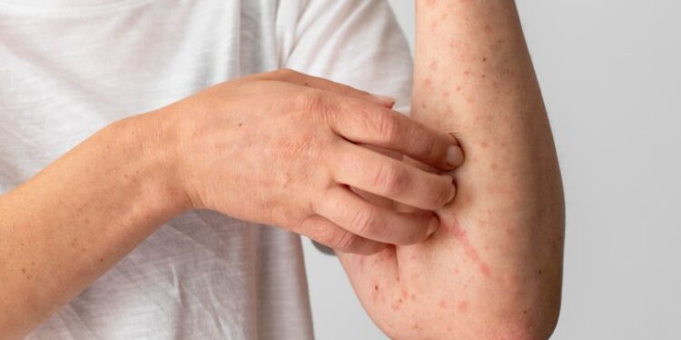 Piauí tem quase 700 novos casos de hanseníase; veja os sintomas da doença