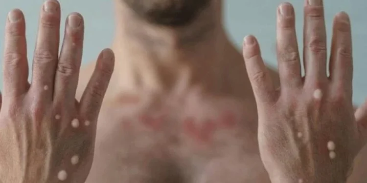 Mpox: Ministério da Saúde confirma primeiro caso da cepa 1b em paciente de São Paulo